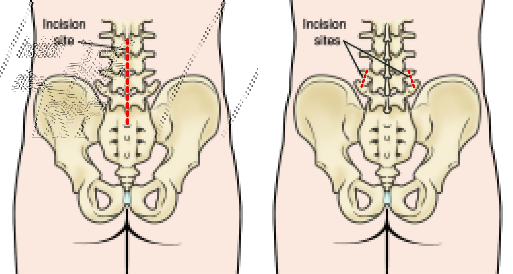 Endoscopic vs. Open Back Surgery